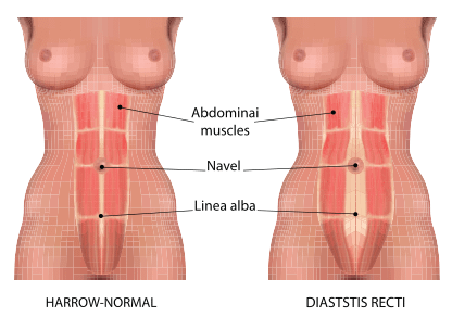 腹直肌分離（Rectus Diastasis）是什麼？產後要