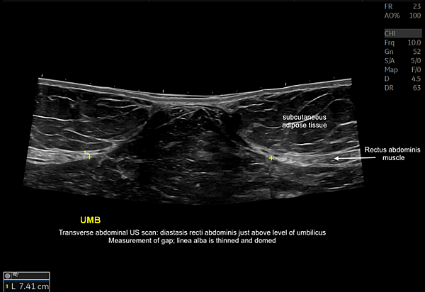 腹直肌分離（Rectus Diastasis）是什麼？產後要