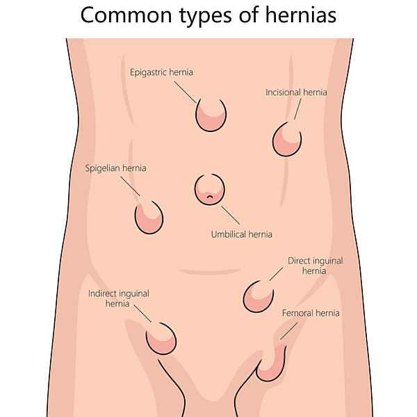 腹直肌分離（Rectus Diastasis）是什麼？產後要