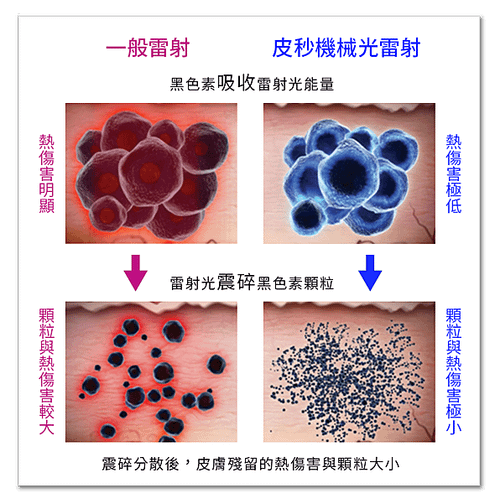 755蜂巢皮秒雷射蜂巢透鏡PicoSure淨膚雷射飛梭雷射1.png