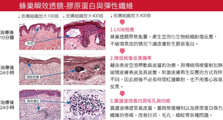 PicoSure皮秒雷射蜂巢透鏡755蜂巢皮秒雷射膠原蛋白FDA認證痘疤刺青黑色素斑點 (2).jpg