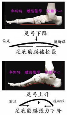 足底筋膜炎