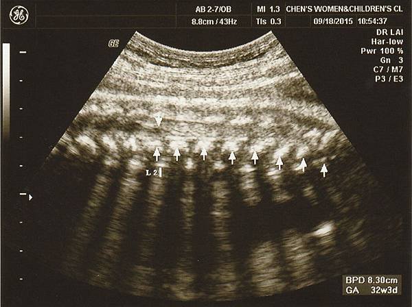 conus medullaris 32 weeks