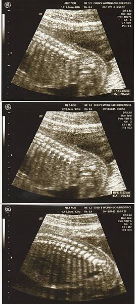 conus medullaris 20 weeks