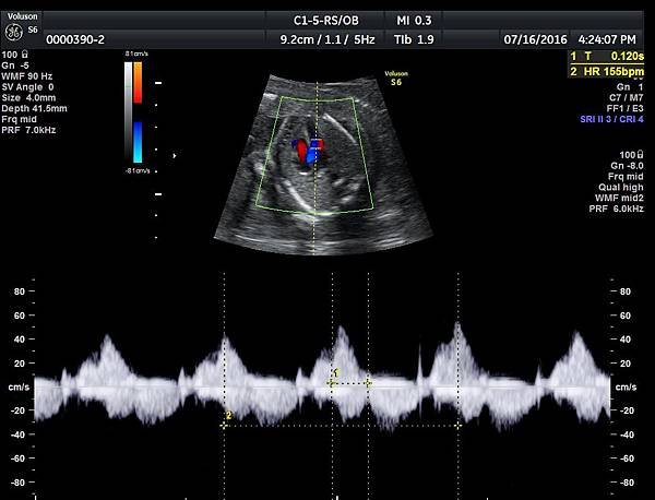 pr interval 01