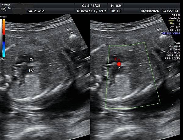 孕兒診所賴錫鉅醫師 425 諮詢的壓力遠大於常規高層次超音波