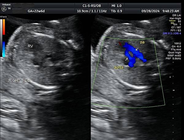 孕兒診所賴錫鉅醫師 439 產前診斷單一心室案例分享 : 有