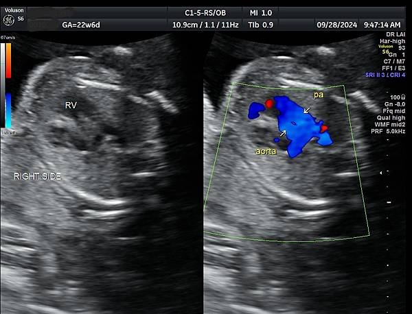 孕兒診所賴錫鉅醫師 439 產前診斷單一心室案例分享 : 有