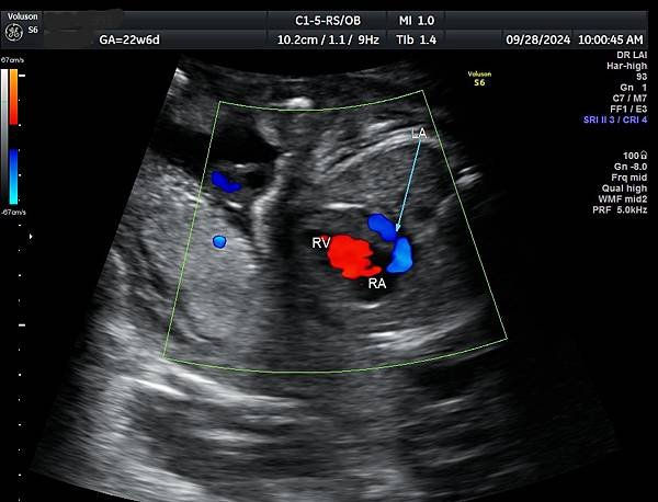 孕兒診所賴錫鉅醫師 439 產前診斷單一心室案例分享 : 有
