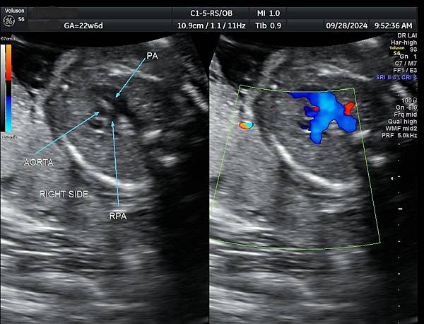 孕兒診所賴錫鉅醫師 439 產前診斷單一心室案例分享 : 有