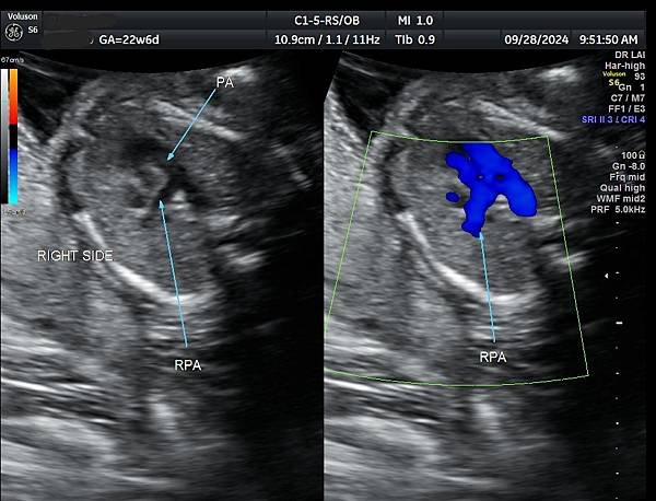 孕兒診所賴錫鉅醫師 439 產前診斷單一心室案例分享 : 有