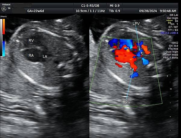 孕兒診所賴錫鉅醫師 439 產前診斷單一心室案例分享 : 有