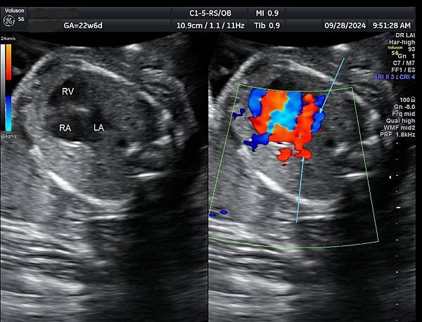 孕兒診所賴錫鉅醫師 439 產前診斷單一心室案例分享 : 有