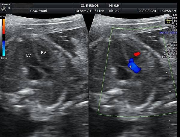 孕兒診所賴錫鉅醫師 440 輕微型法洛氏心臟病案例分享 : 