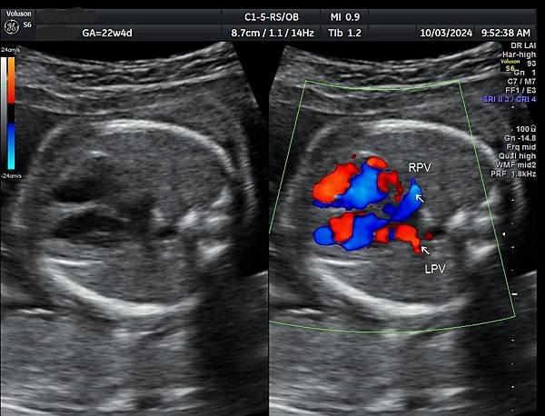 孕兒診所賴錫鉅醫師 442 胎兒肺靜脈如何檢查經驗分享 - 