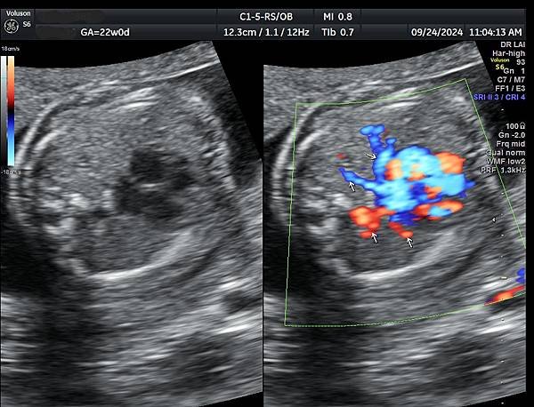 孕兒診所賴錫鉅醫師 442 胎兒肺靜脈如何檢查經驗分享 - 