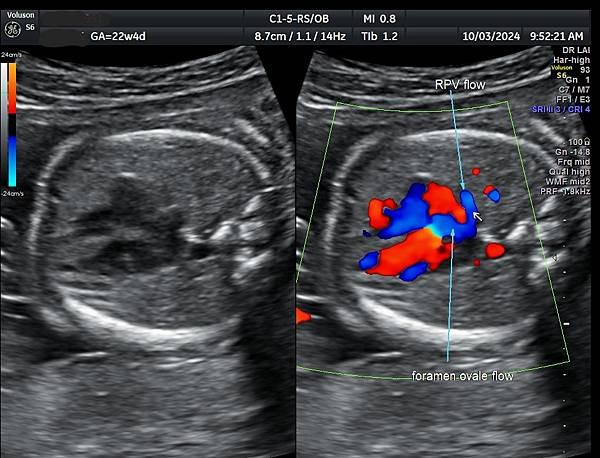 孕兒診所賴錫鉅醫師 442 胎兒肺靜脈如何檢查經驗分享 - 