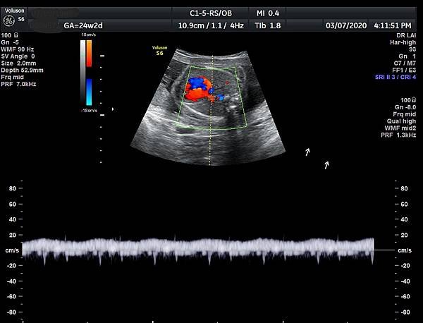 孕兒診所賴錫鉅醫師 442 胎兒肺靜脈如何檢查經驗分享 - 