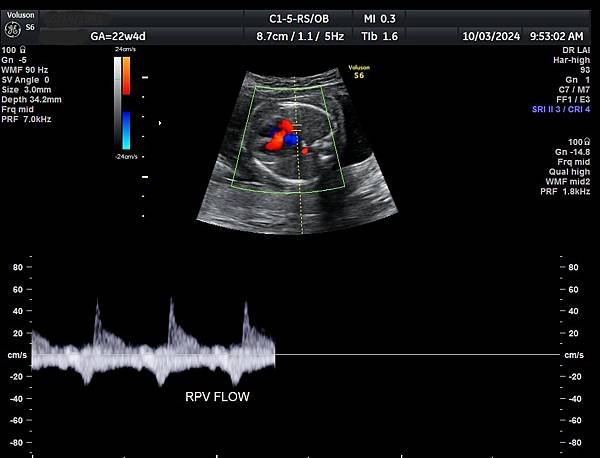 孕兒診所賴錫鉅醫師 442 胎兒肺靜脈如何檢查經驗分享 - 