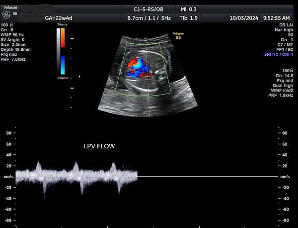 孕兒診所賴錫鉅醫師 442 胎兒肺靜脈如何檢查經驗分享 - 