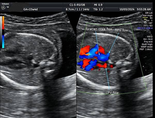 孕兒診所賴錫鉅醫師 442 胎兒肺靜脈如何檢查經驗分享 - 