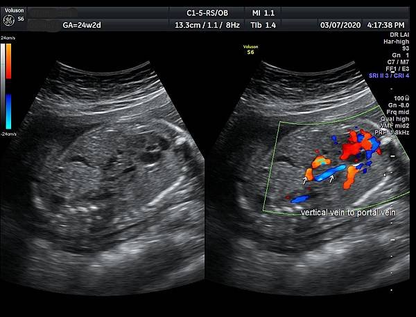 孕兒診所賴錫鉅醫師 442 胎兒肺靜脈如何檢查經驗分享 - 