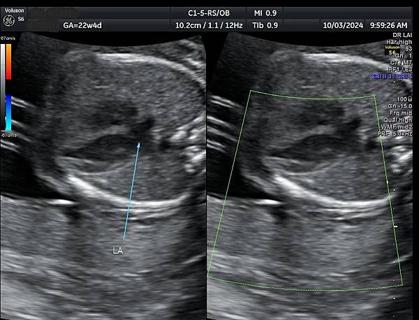 孕兒診所賴錫鉅醫師 442 胎兒肺靜脈如何檢查經驗分享 - 