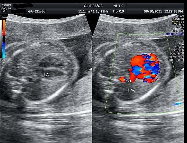孕兒診所賴錫鉅醫師 443 胎兒肺靜脈如何檢查經驗分享- p