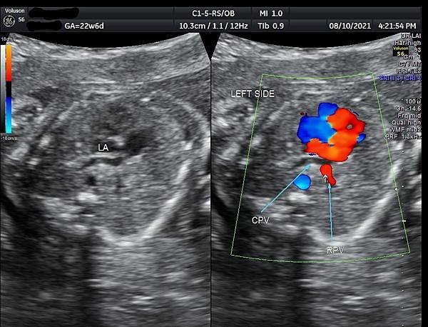 孕兒診所賴錫鉅醫師 443 胎兒肺靜脈如何檢查經驗分享- p