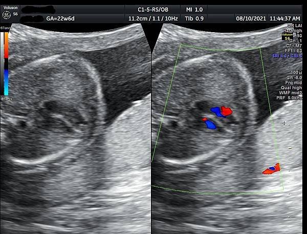 孕兒診所賴錫鉅醫師 443 胎兒肺靜脈如何檢查經驗分享- p