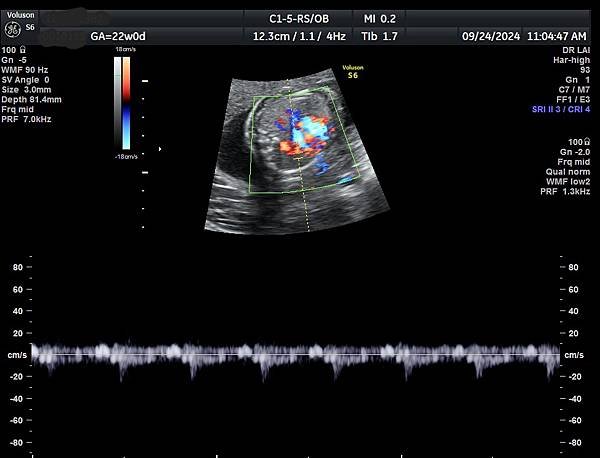 孕兒診所賴錫鉅醫師 443 胎兒肺靜脈如何檢查經驗分享- p