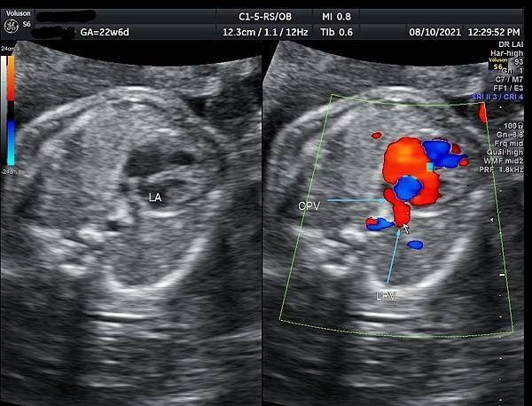 孕兒診所賴錫鉅醫師 443 胎兒肺靜脈如何檢查經驗分享- p