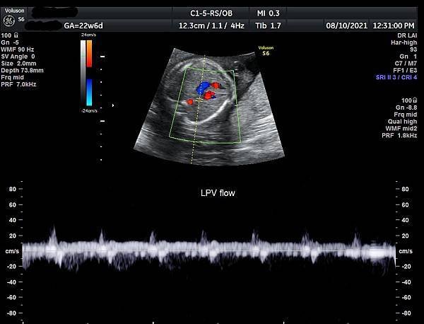孕兒診所賴錫鉅醫師 443 胎兒肺靜脈如何檢查經驗分享- p
