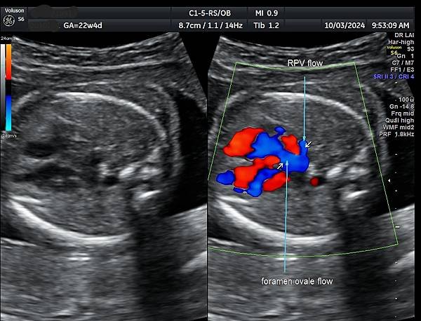 孕兒診所賴錫鉅醫師 443 胎兒肺靜脈如何檢查經驗分享- p