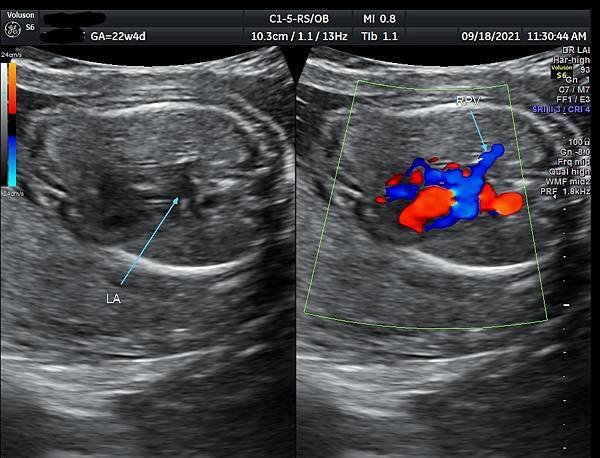 孕兒診所賴錫鉅醫師 443 胎兒肺靜脈如何檢查經驗分享- p