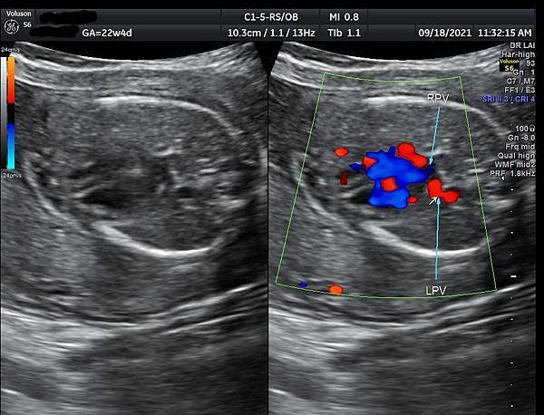 孕兒診所賴錫鉅醫師 443 胎兒肺靜脈如何檢查經驗分享- p