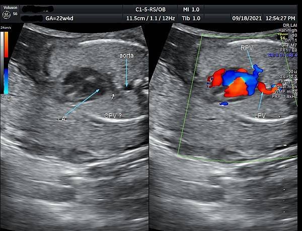 孕兒診所賴錫鉅醫師 443 胎兒肺靜脈如何檢查經驗分享- p