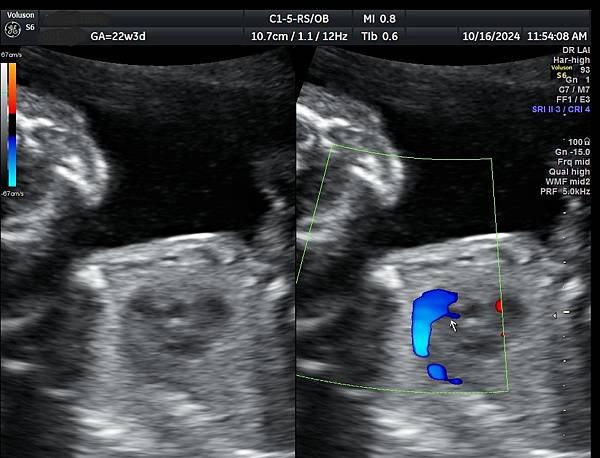 孕兒診所賴錫鉅醫師 445 胎兒心臟超音波的切面經驗分享 :