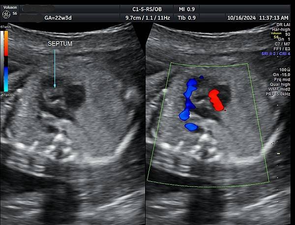 孕兒診所賴錫鉅醫師 445 胎兒心臟超音波的切面經驗分享 :