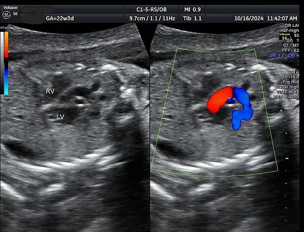 孕兒診所賴錫鉅醫師 445 胎兒心臟超音波的切面經驗分享 :