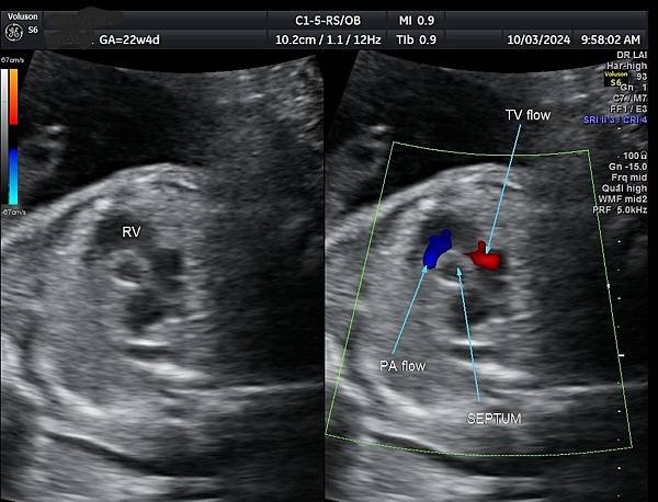 孕兒診所賴錫鉅醫師 445 胎兒心臟超音波的切面經驗分享 :