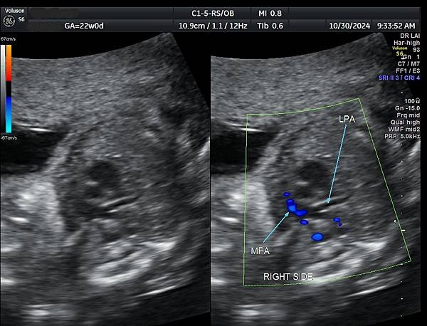 孕兒診所賴錫鉅醫師 446 產前診斷血管環可以避免新生兒缺氧