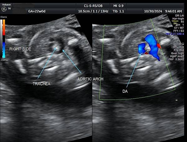 孕兒診所賴錫鉅醫師 446 產前診斷血管環可以避免新生兒缺氧
