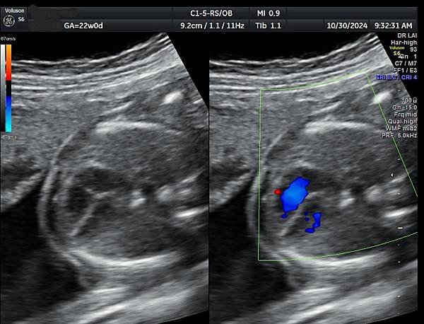 孕兒診所賴錫鉅醫師 446 產前診斷血管環可以避免新生兒缺氧