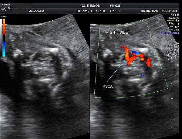 孕兒診所賴錫鉅醫師 446 產前診斷血管環可以避免新生兒缺氧