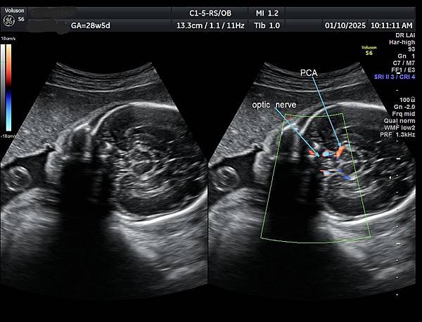 孕兒診所賴錫鉅醫師 451 胎兒腦部視神經如何檢查經驗分享 
