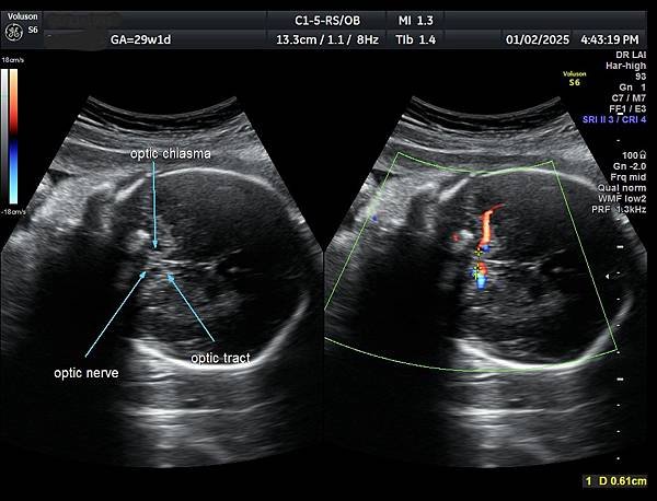 孕兒診所賴錫鉅醫師 451 胎兒腦部視神經如何檢查經驗分享 