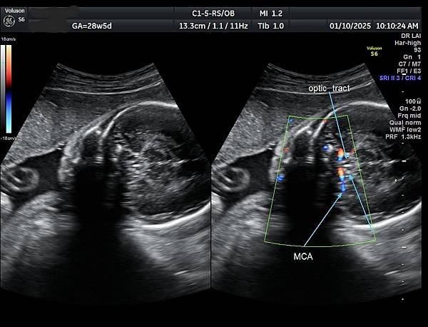 孕兒診所賴錫鉅醫師 451 胎兒腦部視神經如何檢查經驗分享 