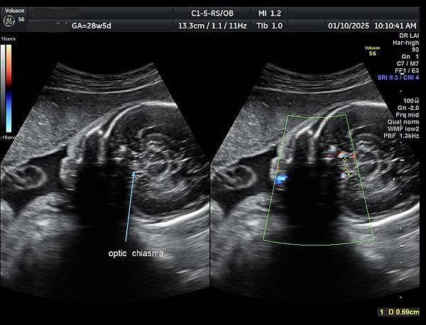 孕兒診所賴錫鉅醫師 451 胎兒腦部視神經如何檢查經驗分享 
