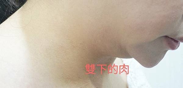 讓新手媽咪找回自信的容脂療程+肉毒輪廓[永欣診所醫美專業諮詢